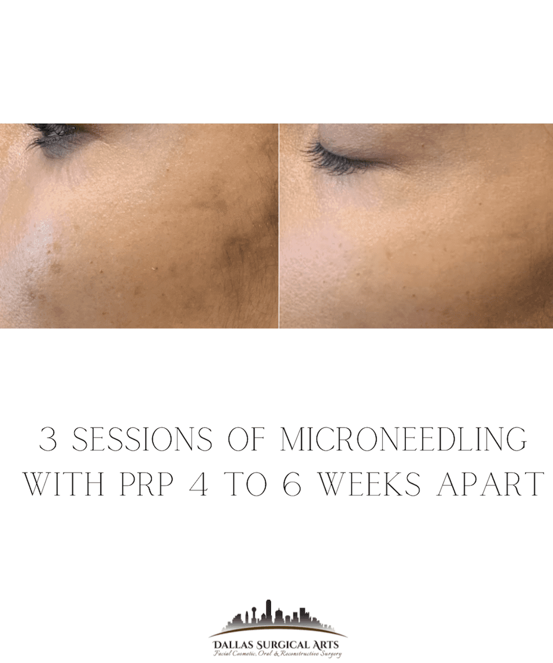The Benefits of Microneedling: Rejuvenate Your Skin at Dallas Surgical Arts